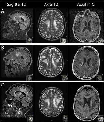 Case Report: A Case of Severe Clinical Deterioration in a Patient With Multiple Sclerosis